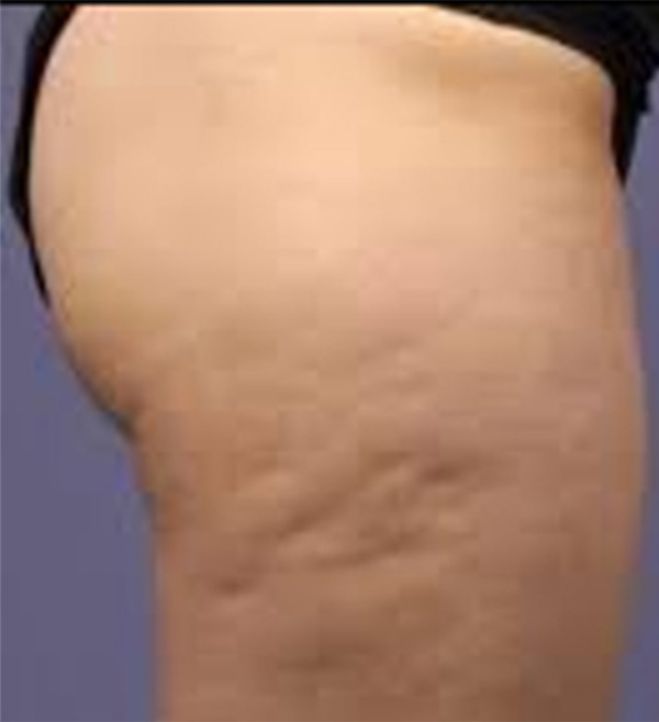Tratamiento Anti Celulitis